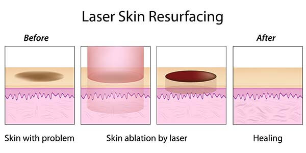 laser-scar-removal-whittier