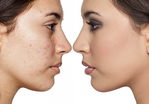 san-fernando-valley-acne-removal